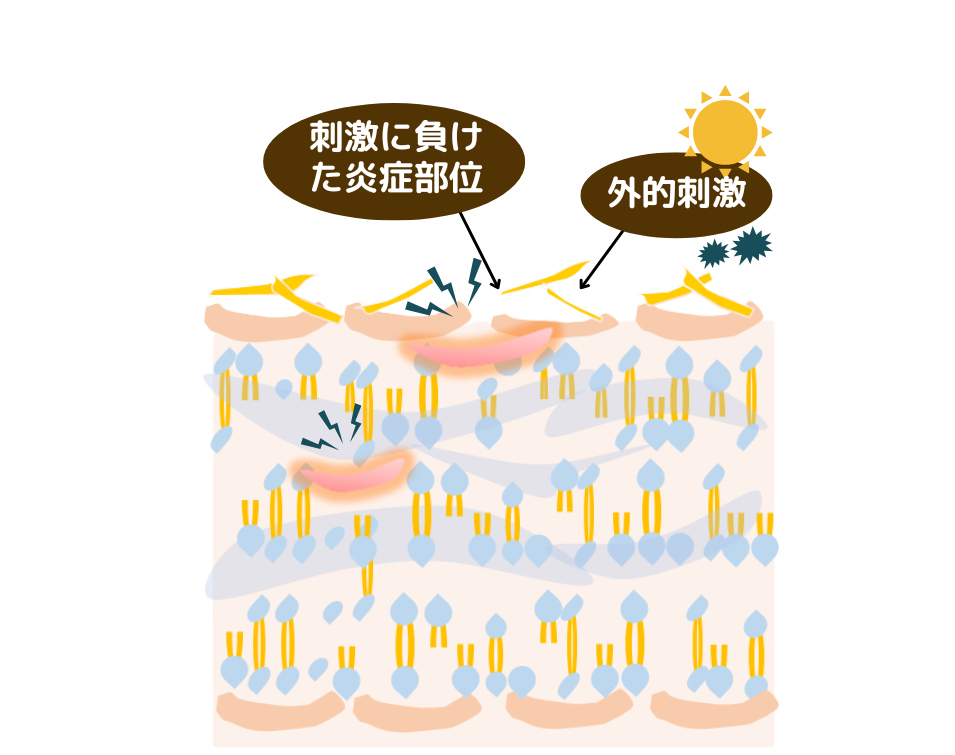 ラメラ構造が乱れた肌